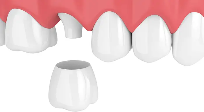 crowns and bridges