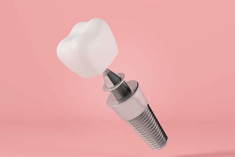 dental implant sacramento