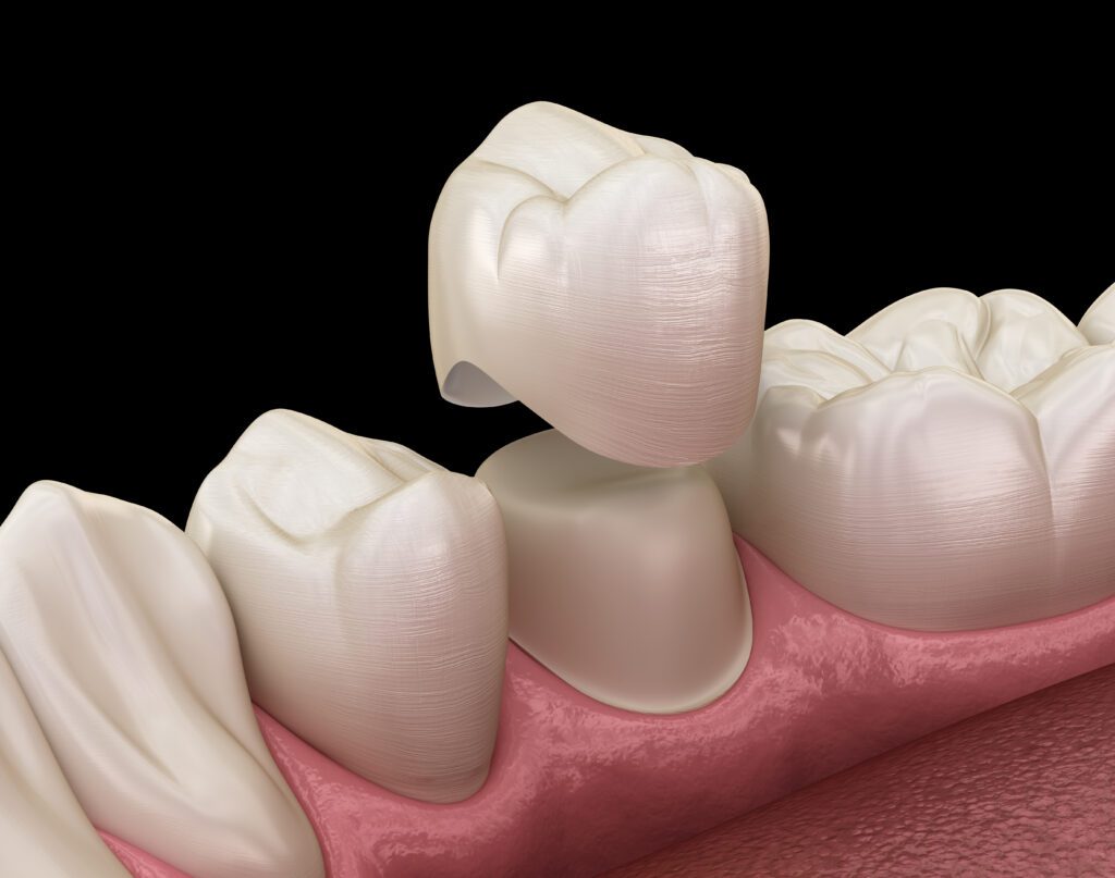 Dental Crowns in Sacramento